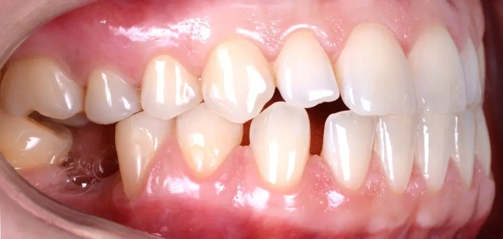 Мезиальный прикус - Кейс 5 — боковой ракурс до лечения