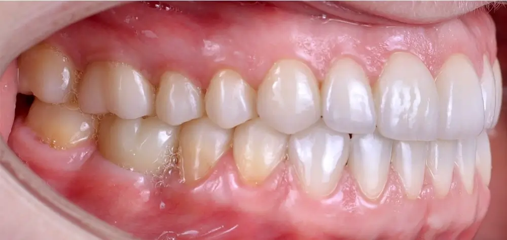 Мезиальный прикус - Кейс 5 — боковой ракурс после лечения