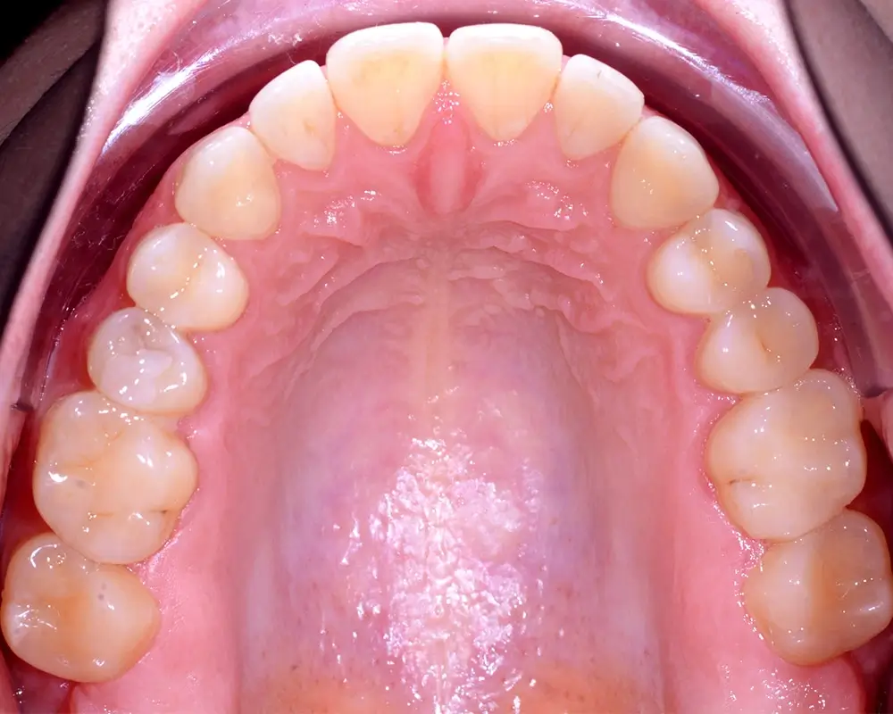 Мезиальный прикус - Кейс 5 — верхняя челюсть до лечения