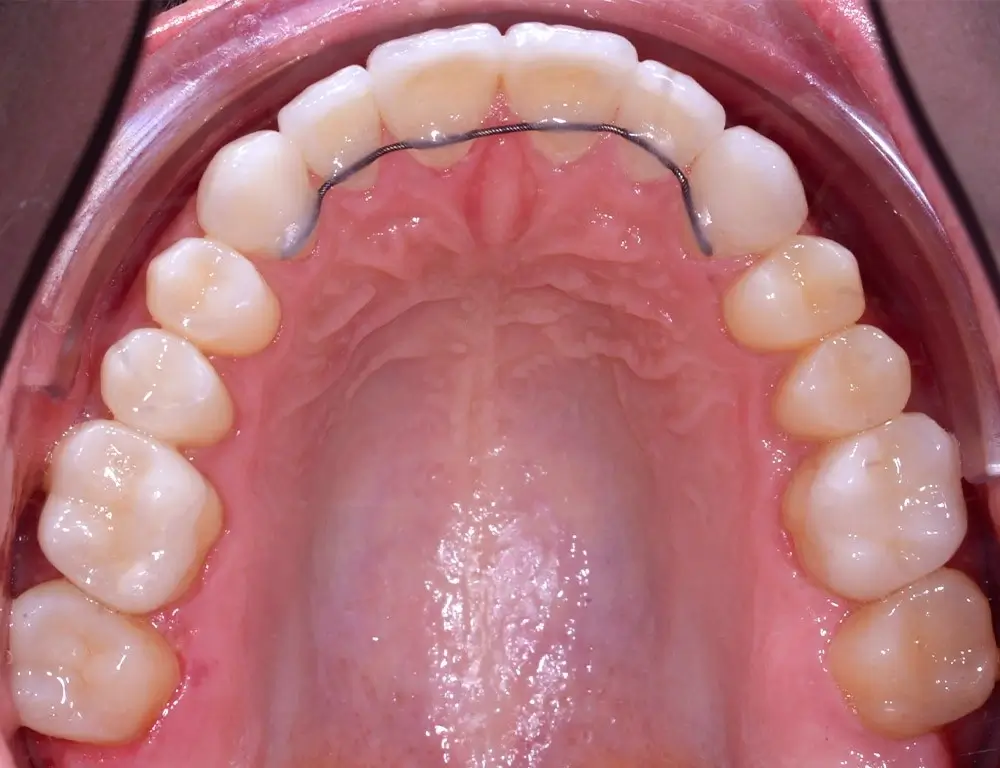 Мезиальный прикус - Кейс 5 — верхняя челюсть после лечения