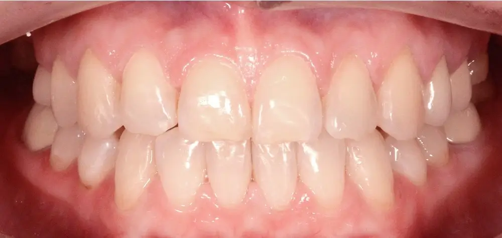 Мезиальный прикус - Кейс 6 — вид спереди после лечения