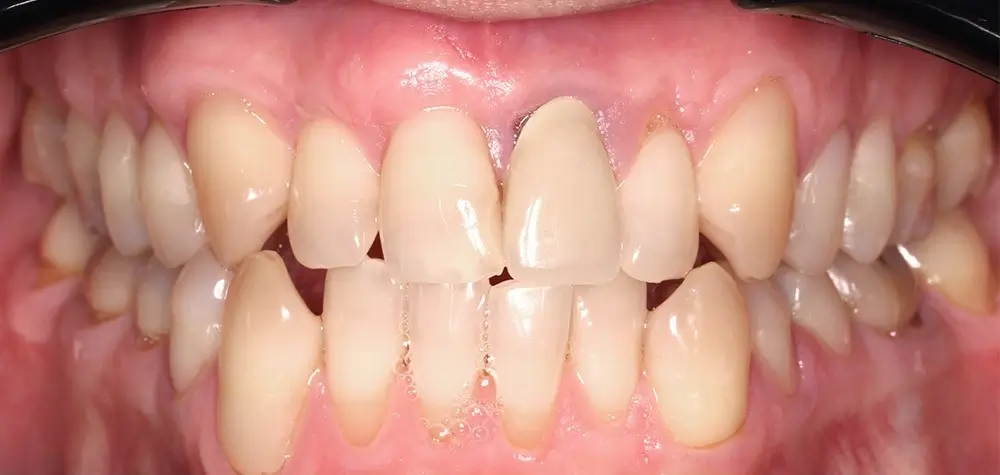 Мезиальный прикус - Кейс 7 — вид спереди до лечения