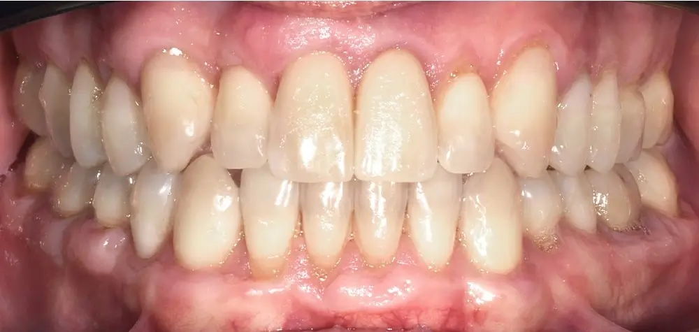 Мезиальный прикус - Кейс 7 — вид спереди после лечения