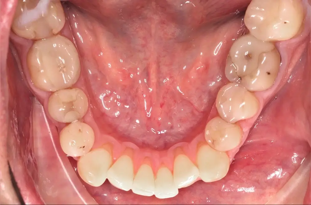 Мезиальный прикус - Кейс 7 — нижняя челюсть до лечения