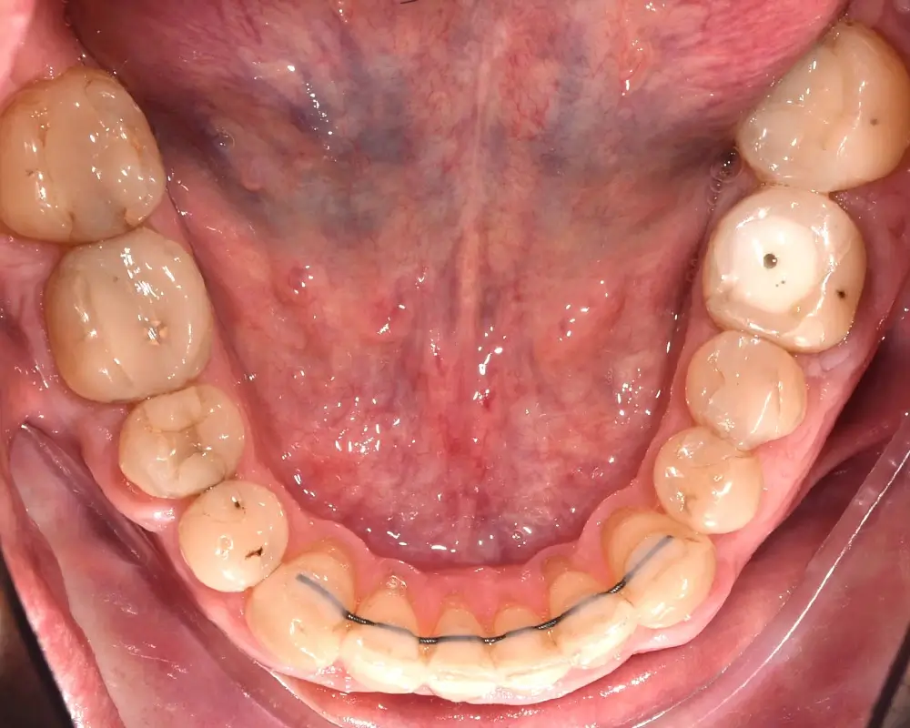 Мезиальный прикус - Кейс 7 — нижняя челюсть после лечения