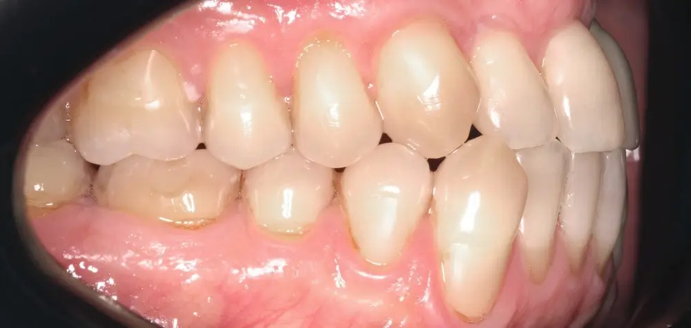 Мезиальный прикус - Кейс 7 — боковой ракурс до лечения