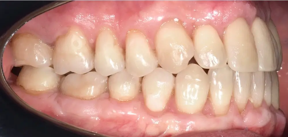 Мезиальный прикус - Кейс 7 — боковой ракурс после лечения