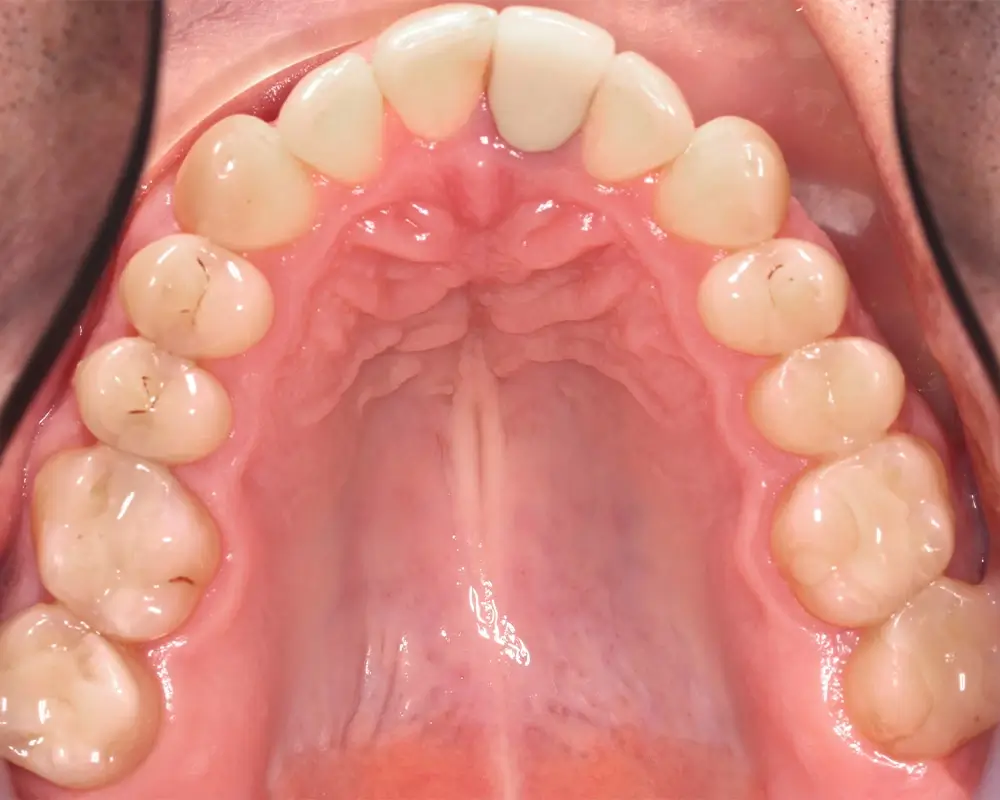 Мезиальный прикус - Кейс 7 — верхняя челюсть до лечения