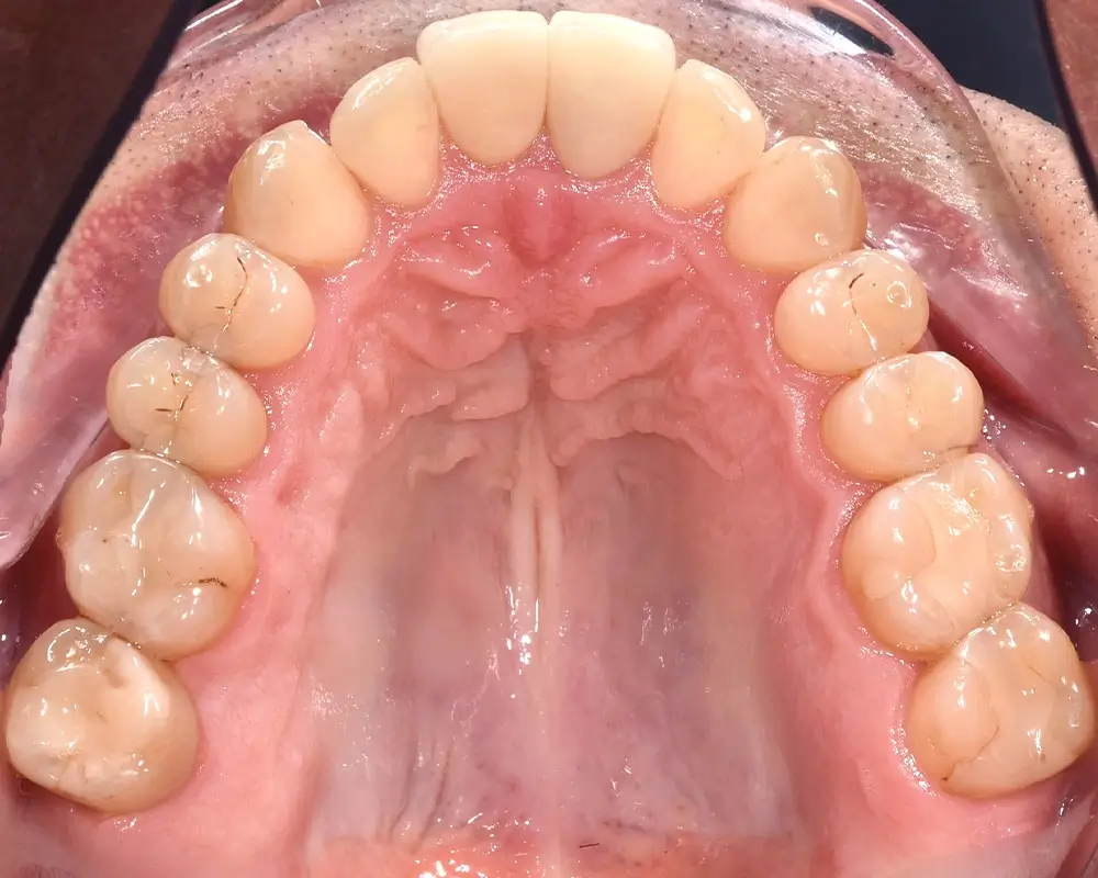 Мезиальный прикус - Кейс 7 — верхняя челюсть после лечения