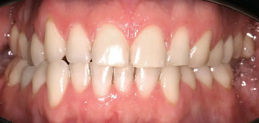 Мезиальный прикус - Кейс 8 — вид спереди до лечения