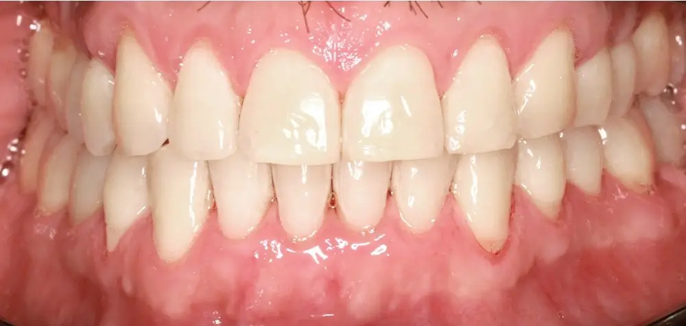 Мезиальный прикус - Кейс 8 — вид спереди после лечения