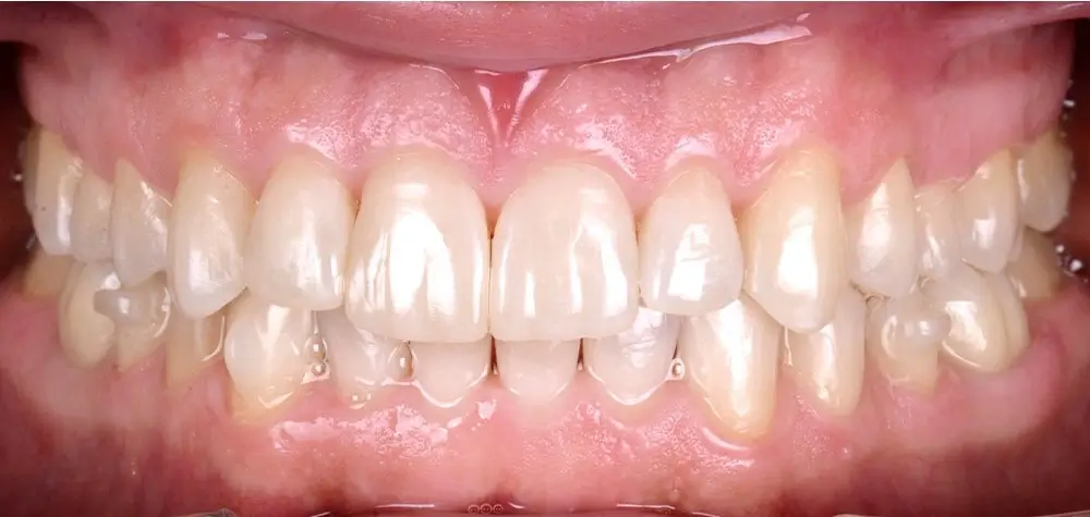 Перекрестный прикус - Кейс 1 — вид спереди после лечения