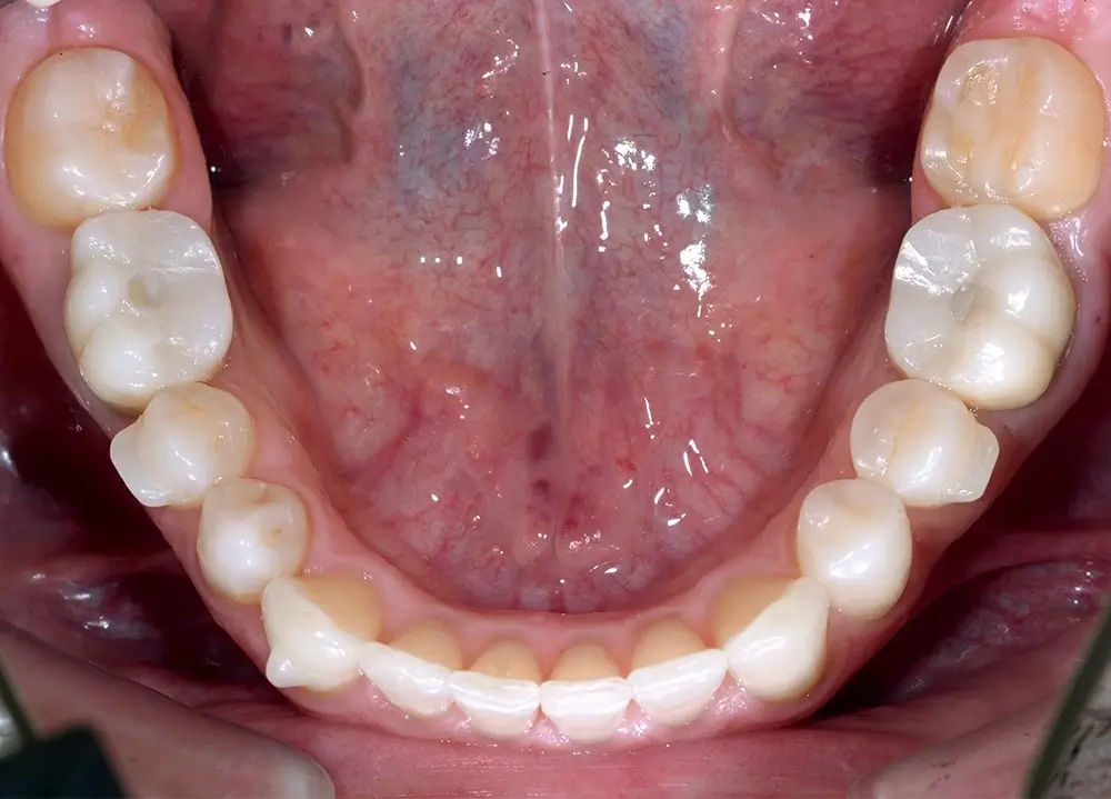 Перекрестный прикус - Кейс 1 — нижняя челюсть после лечения