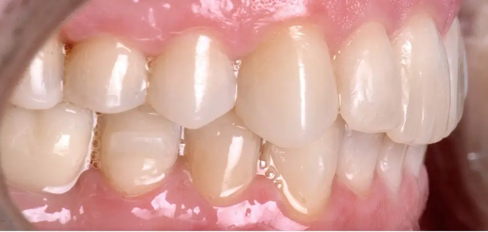 Перекрестный прикус - Кейс 1 — боковой ракурс после лечения