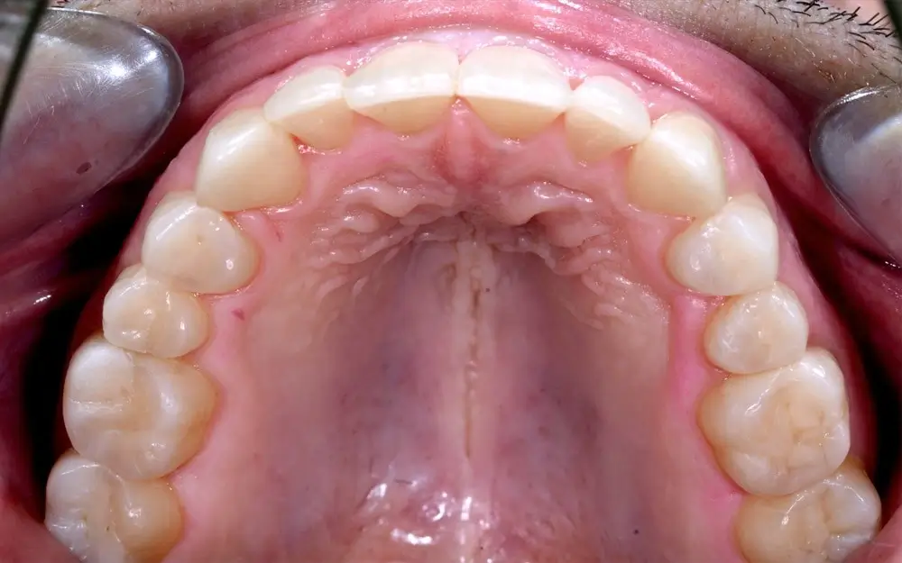 Перекрестный прикус - Кейс 1 — верхняя челюсть после лечения