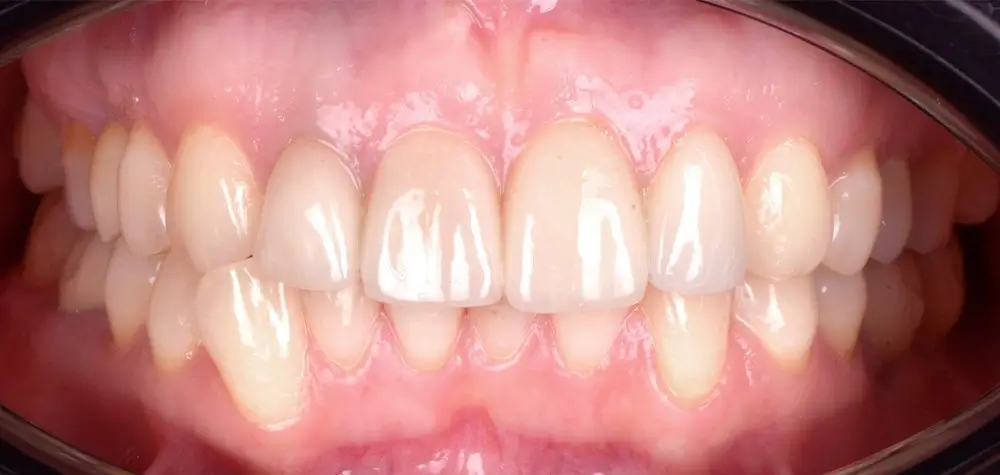 Перекрестный прикус - Кейс 10 — фронтальный ракурс до лечения