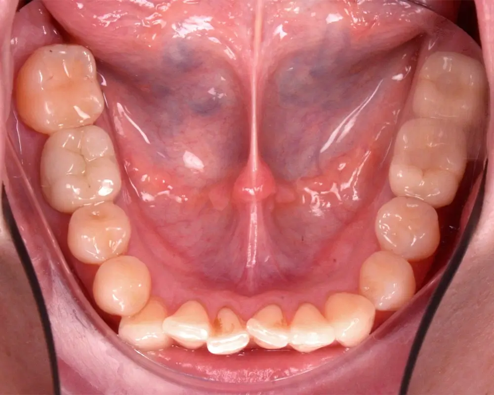 Перекрестный прикус - Кейс 10 — нижняя челюсть до лечения