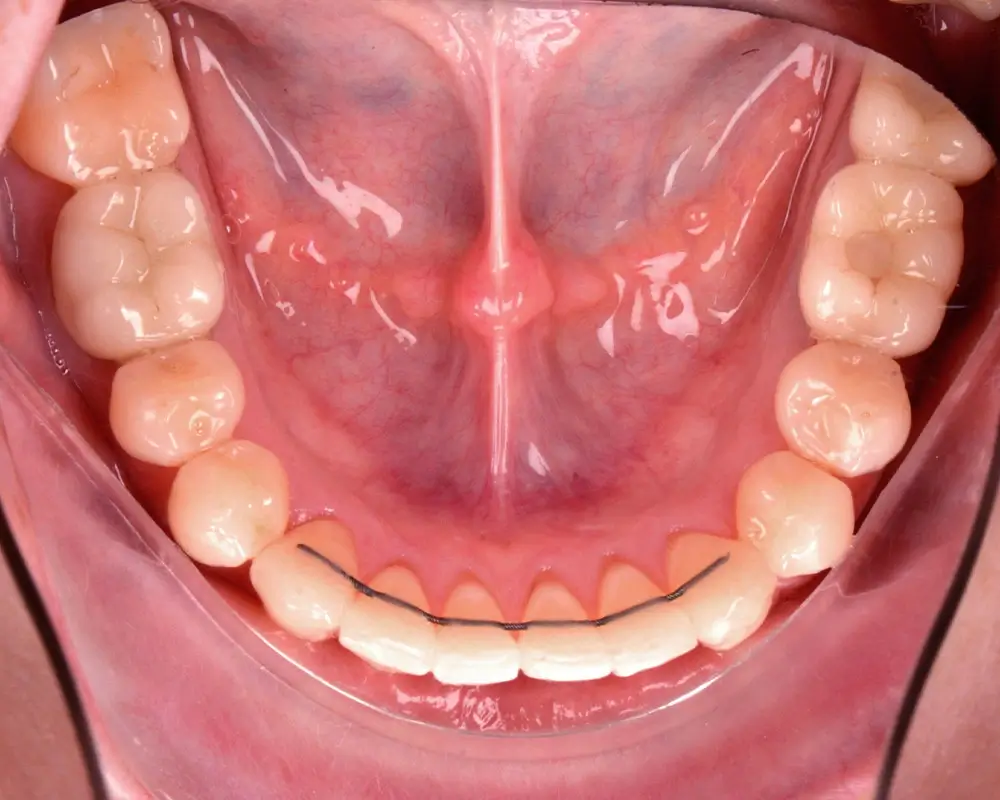 Перекрестный прикус - Кейс 10 — нижняя челюсть после лечения