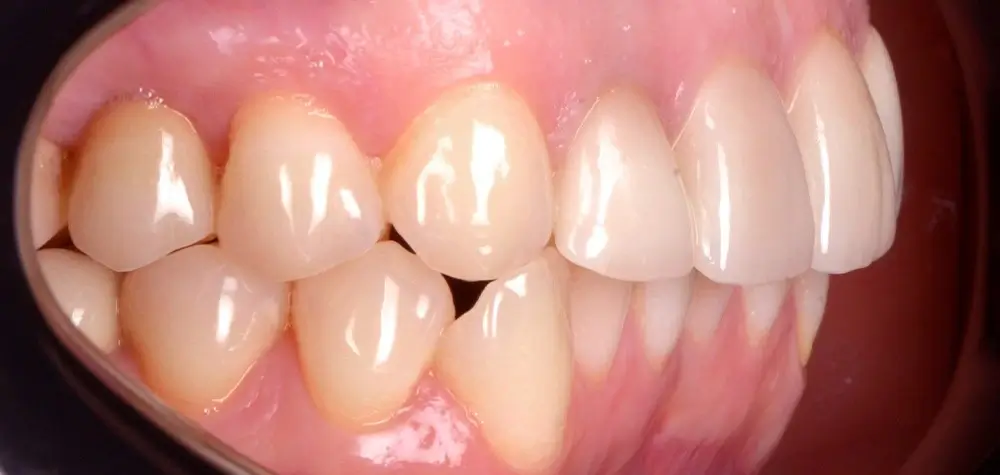 Перекрестный прикус - Кейс 10 — боковой ракурс до лечения