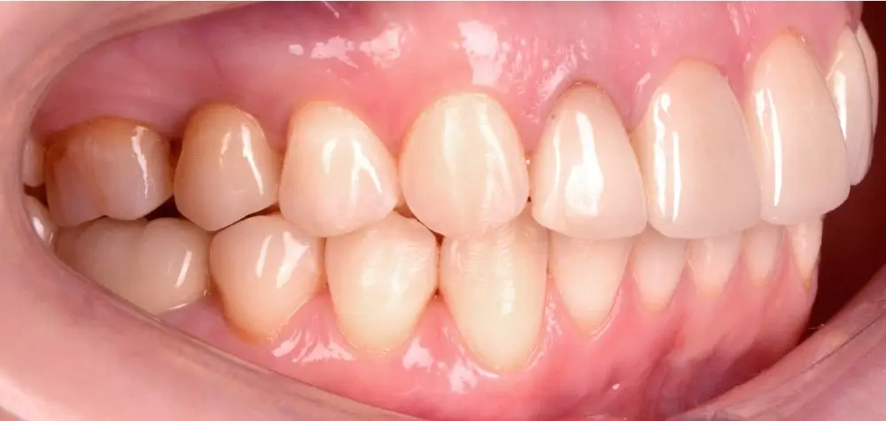 Перекрестный прикус - Кейс 10 — боковой ракурс после лечения