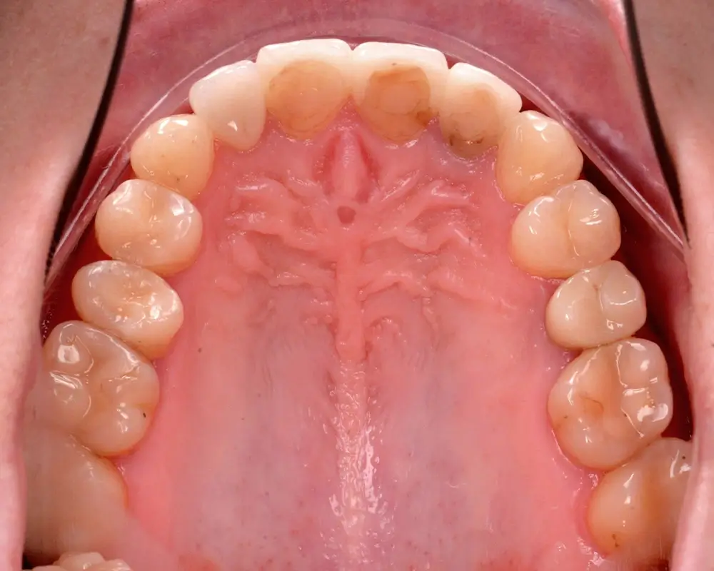 Перекрестный прикус - Кейс 10 — верхняя челюсть до лечения