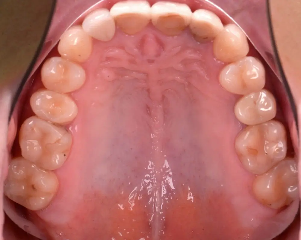 Перекрестный прикус - Кейс 10 — верхняя челюсть после лечения