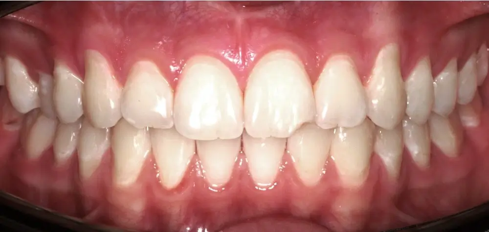 Перекрестный прикус - Кейс 11 — вид спереди после лечения