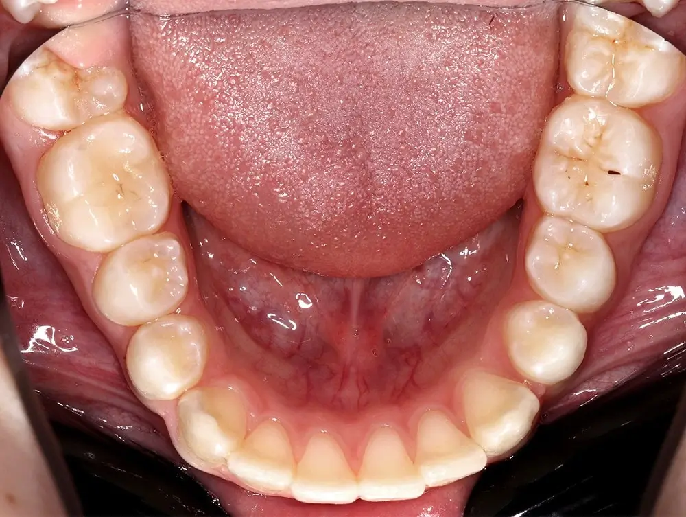 Перекрестный прикус - Кейс 11 — нижняя челюсть до лечения