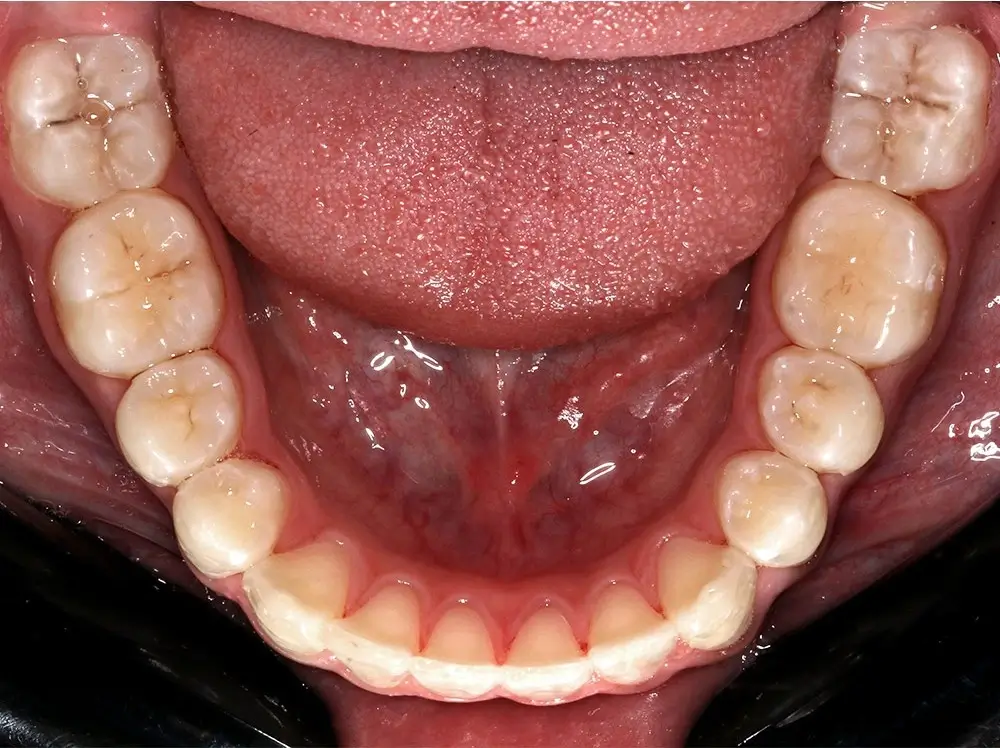 Перекрестный прикус - Кейс 11 — нижняя челюсть после лечения