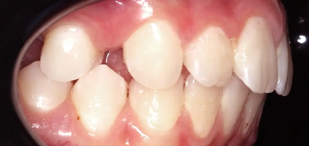 Перекрестный прикус - Кейс 11 — боковой ракурс до лечения