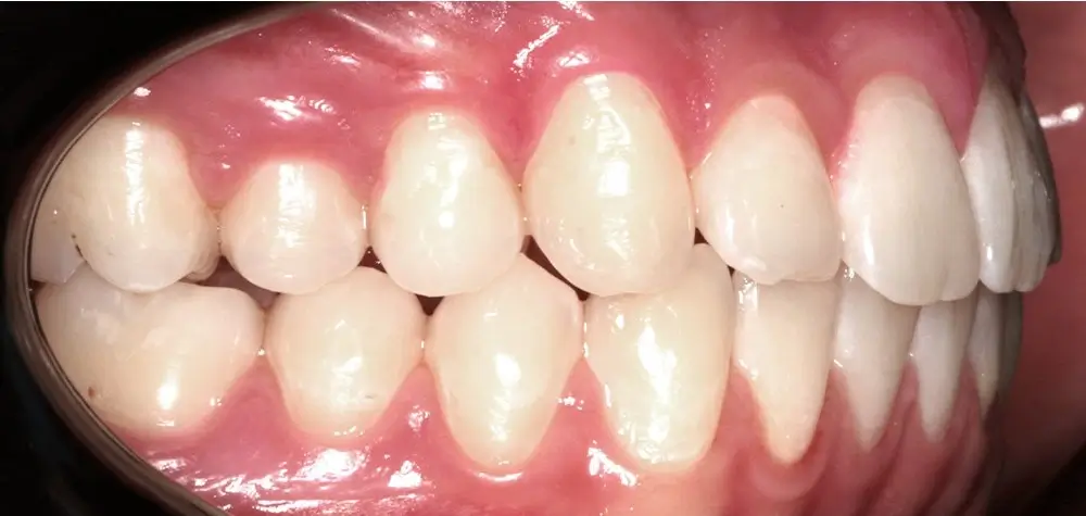 Перекрестный прикус - Кейс 11 — боковой ракурс после лечения