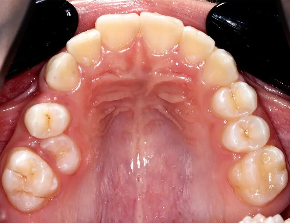 Перекрестный прикус - Кейс 11 — верхняя челюсть до лечения