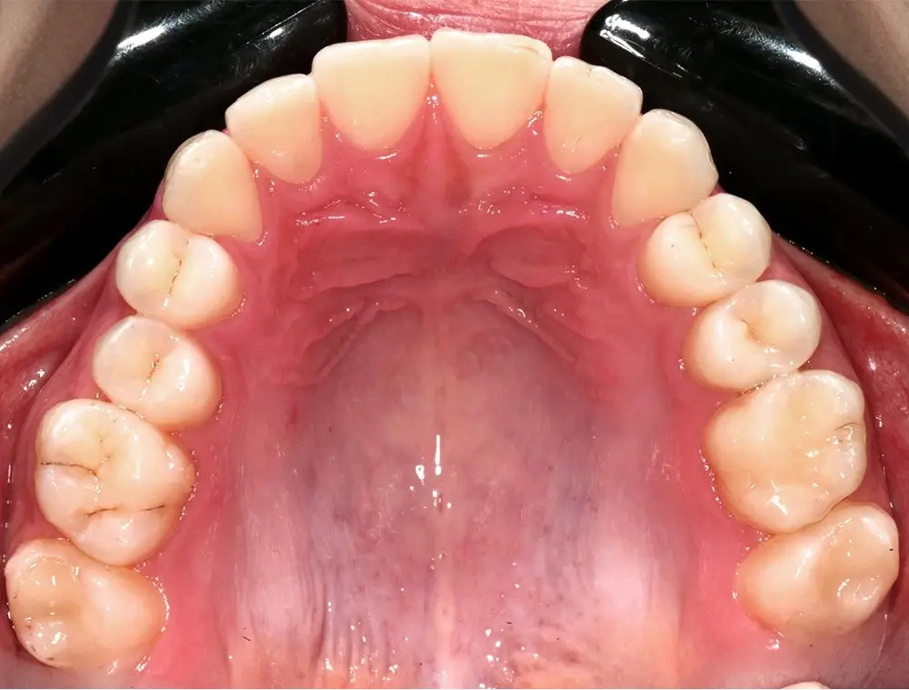 Перекрестный прикус - Кейс 11 — верхняя челюсть после лечения