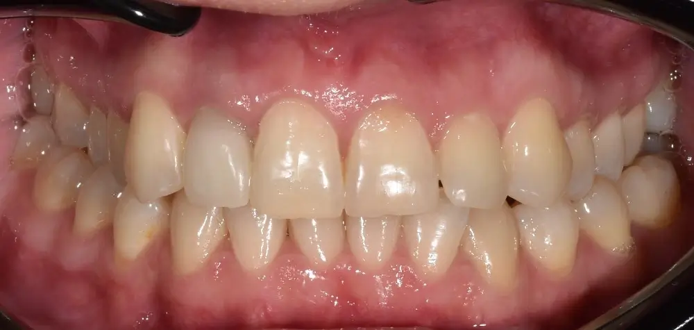 Перекрестный прикус - Кейс 12 — вид спереди до лечения