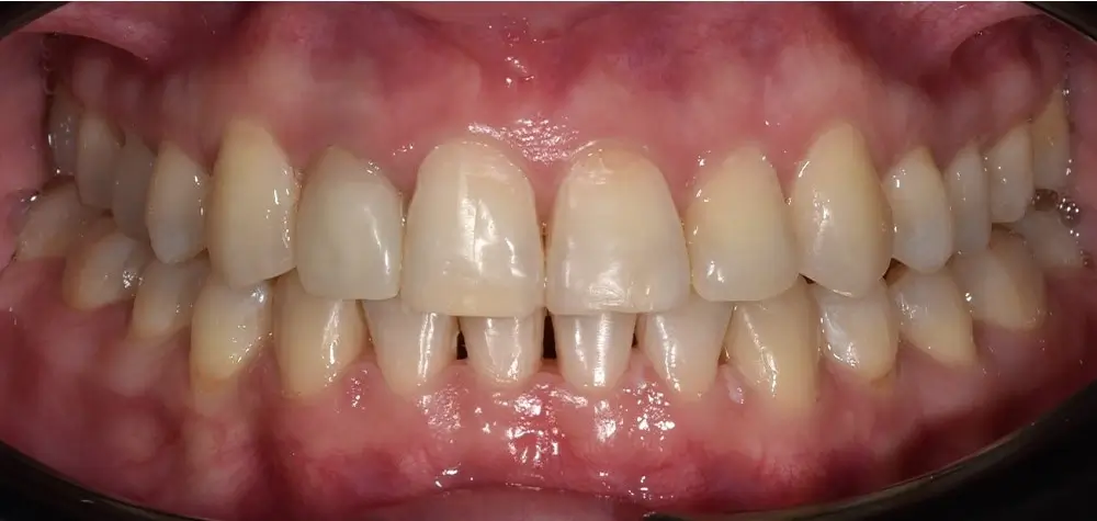 Перекрестный прикус - Кейс 12 — вид спереди после лечения