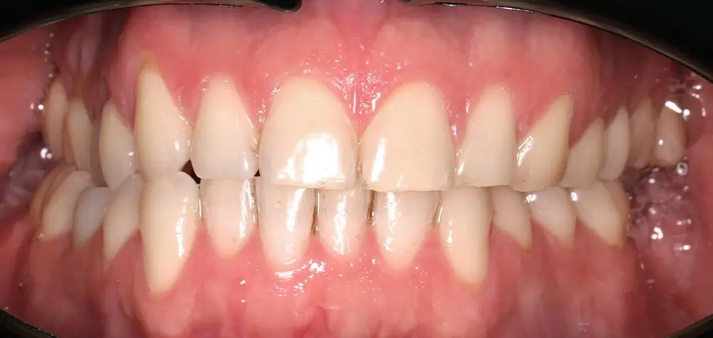 Перекрестный прикус - Кейс 13 — вид спереди до лечения