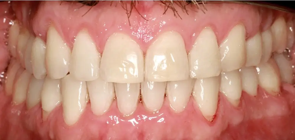 Перекрестный прикус - Кейс 13 — вид спереди после лечения