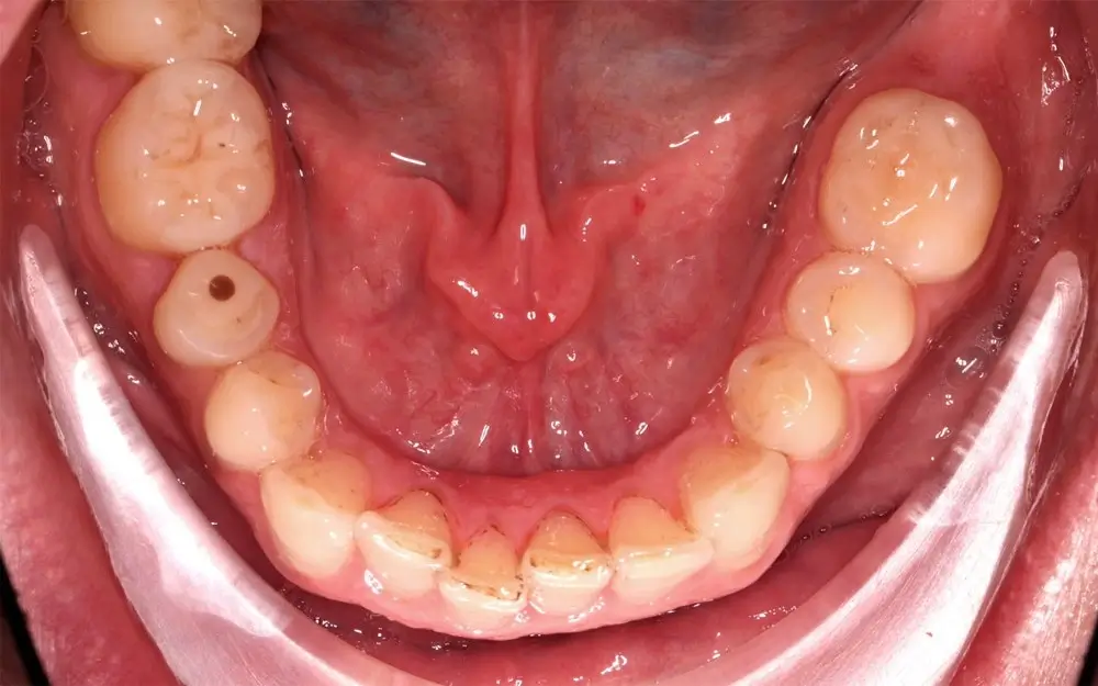 Перекрестный прикус - Кейс 13 — нижняя челюсть до лечения