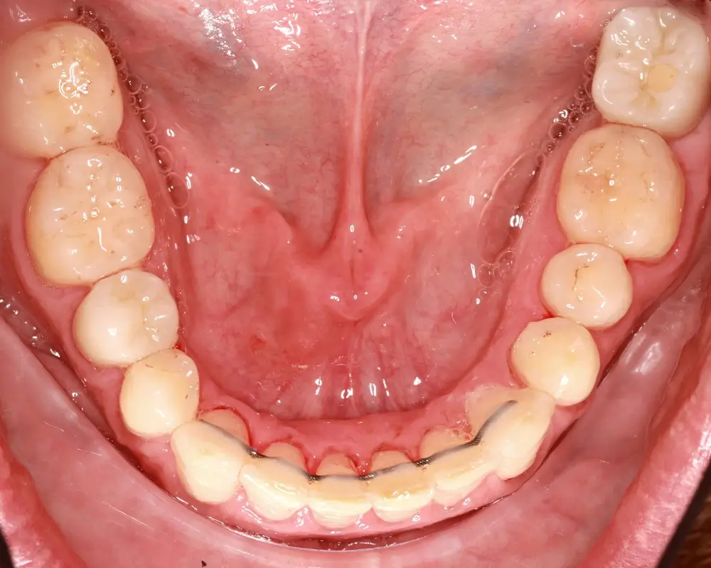 Перекрестный прикус - Кейс 13 — нижняя челюсть после лечения