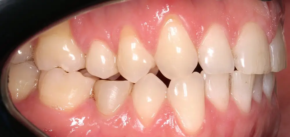 Перекрестный прикус - Кейс 13 — боковой ракурс до лечения