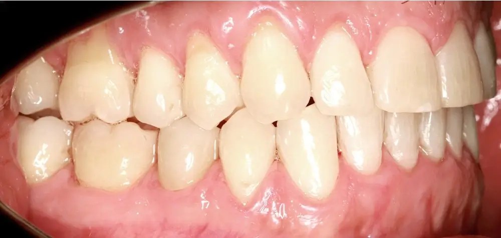 Перекрестный прикус - Кейс 13 — боковой ракурс после лечения