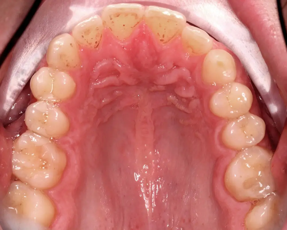 Перекрестный прикус - Кейс 13 — верхняя челюсть до лечения