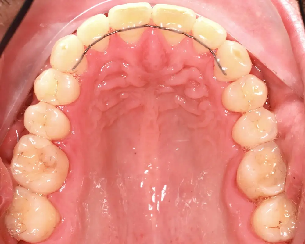 Перекрестный прикус - Кейс 13 — верхняя челюсть после лечения