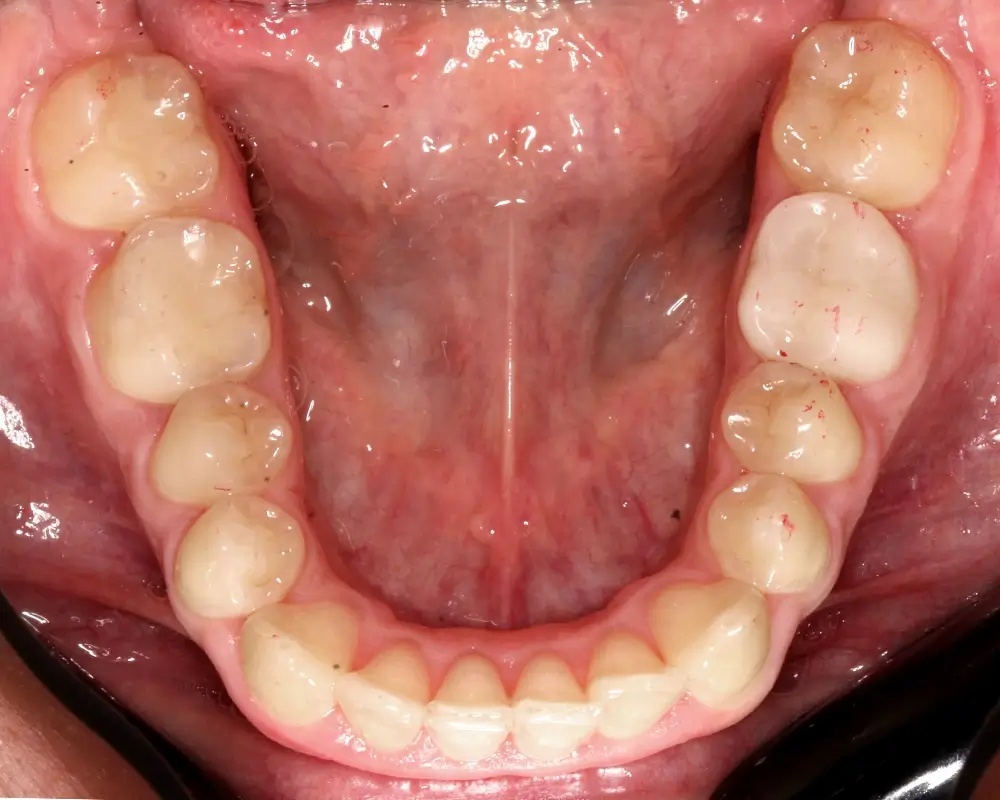 Перекрестный прикус - Кейс 14 — нижняя челюсть до лечения