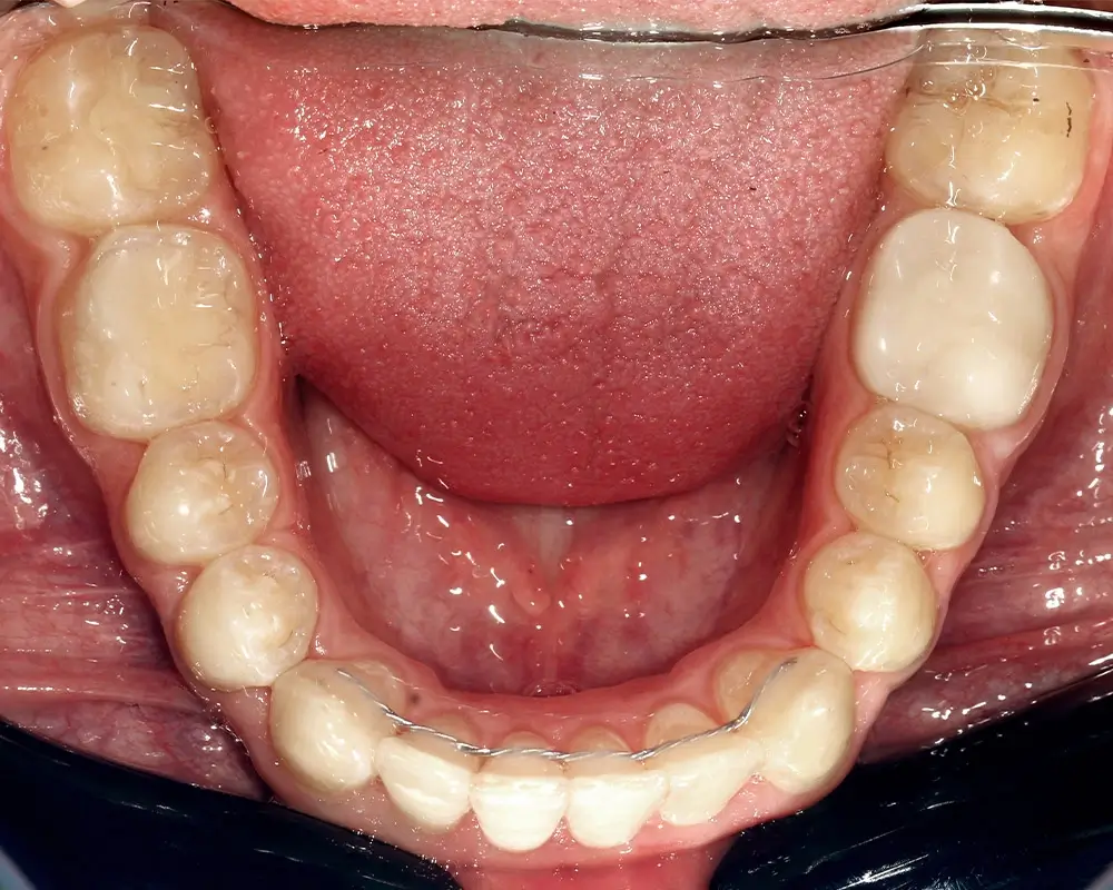 Перекрестный прикус - Кейс 14 — нижняя челюсть после лечения