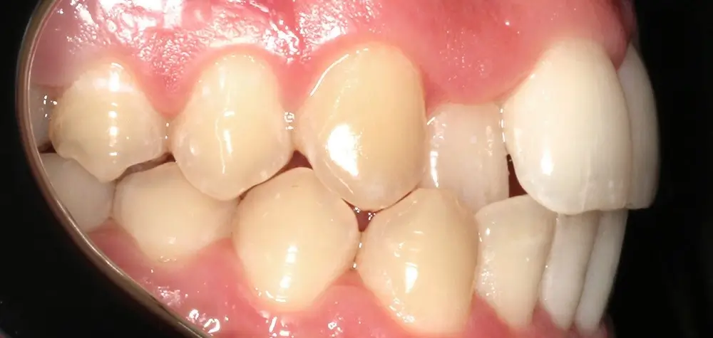 Перекрестный прикус - Кейс 14 — боковой ракурс до лечения