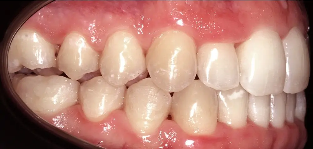 Перекрестный прикус - Кейс 14 — боковой ракурс после лечения