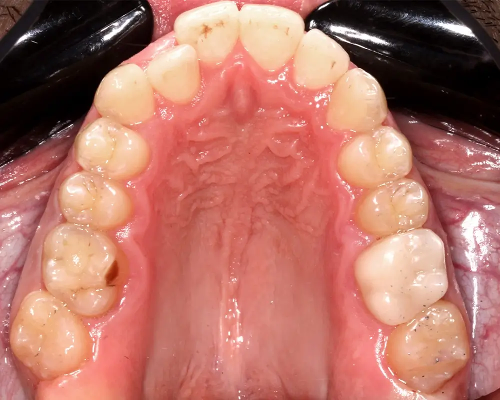 Перекрестный прикус - Кейс 14 — верхняя челюсть до лечения