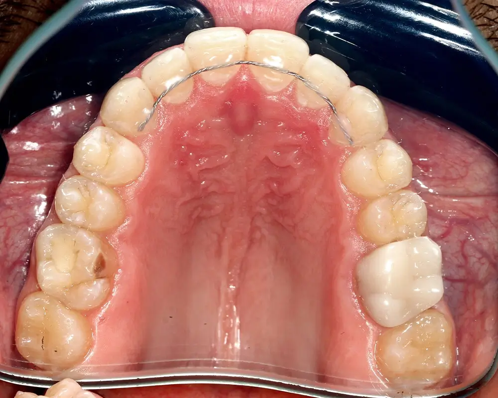 Перекрестный прикус - Кейс 14 — верхняя челюсть после лечения