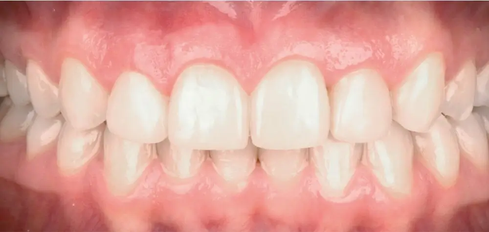 Перекрестный прикус - Кейс 2 — вид спереди после лечения